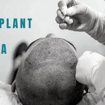 Hair transplant in Nigeria: Important notice